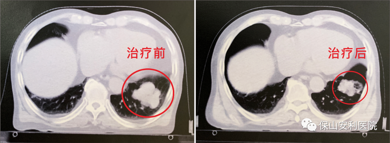 不做手術(shù)，早期肺癌也能根治！
