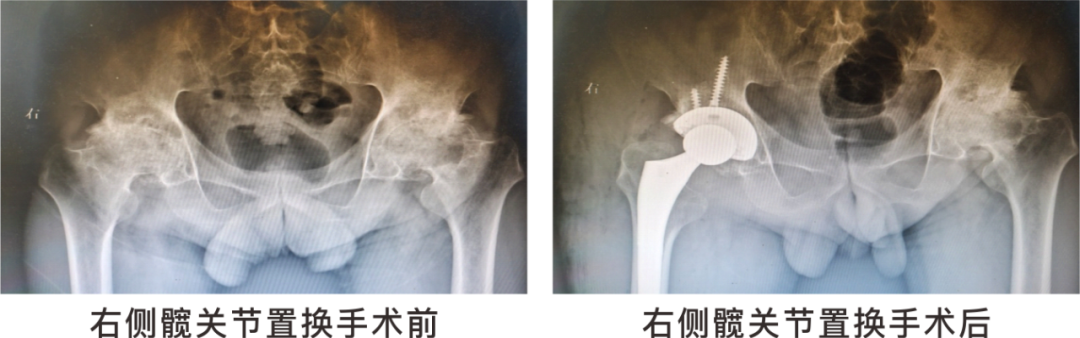 【保山安利醫(yī)院】長期飲酒導致雙側(cè)股骨頭壞死，髖關(guān)節(jié)置換后重獲運動功能！