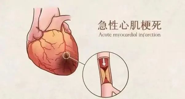 【保山安利醫院】11月20日“心梗救治日” 時間就是心肌，時間就是生命！